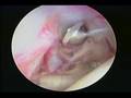 Arthroscopic Shoulder Capsular Release Arthroscopic Shoulder Capsular Release
