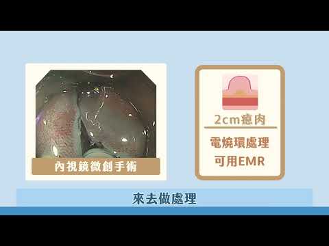 終結早期消化道癌的內視鏡黏膜切除術及黏膜剝離術