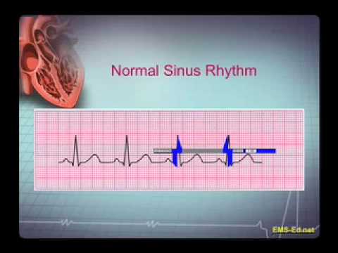 how to read ecg