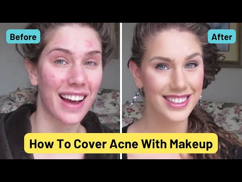 Acne Foundation Routine Flawless Skin (Full Coverage Tutorial) Cystic, Scaring, Oil & Blackheads