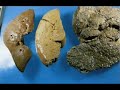 Cirrhosis Cirrhosis
