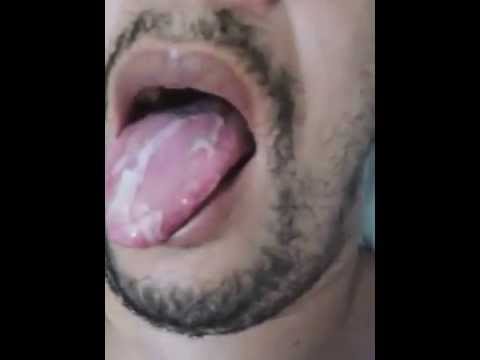 how to treat svc syndrome