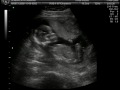 Mataya ultrasound part 2