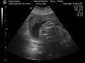 Mike and Kristinas baby Alivia in 3D