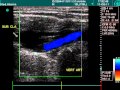 Vertebral Artery, Doppler Echography Vertebral Artery, Doppler Echography
