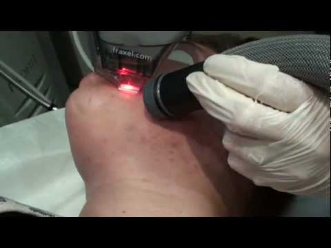 how to get rid of a g tube scar