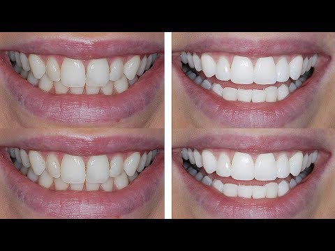 How I Transformed My Teeth!