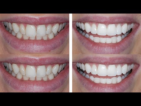 how to whiten bonded teeth