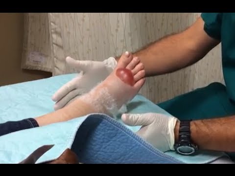 how to drain blister