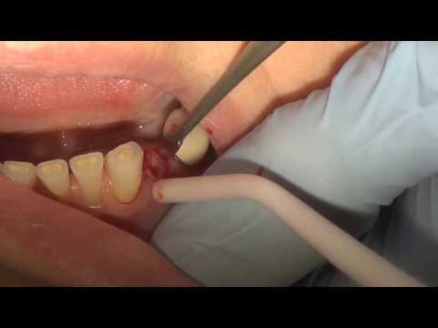 TOOTH!! - How to pull a broken tooth? Watch this video and you will learn how this procedure is done. Please see a dental professional at Art of Dentistry to get help....