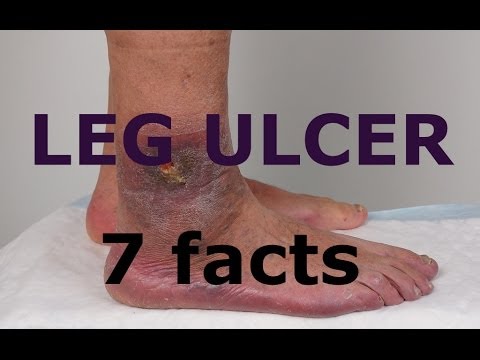 how to treat leg ulcers