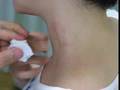 Trigger Point Injection 筋痛症の局所麻酔治療 (むちうち)