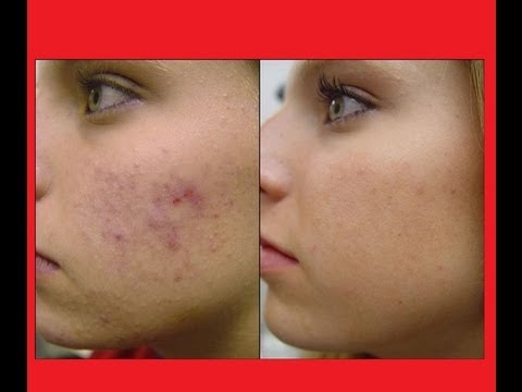 How to Get Rid of Acne Scars Fast and Naturally Overnight