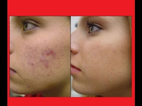 how to get rid of acne scars at home