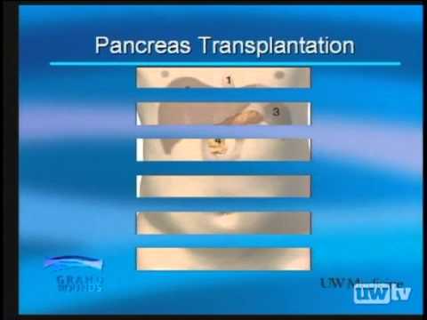 how to qualify for a pancreas transplant