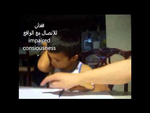 ماذا تعرف عن مرض الصرع