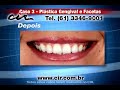Pl�stica Gengival e Facetas CIR Bras�lia (61) 3346-9001
