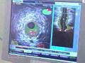 IVUS Vascular Imaging
