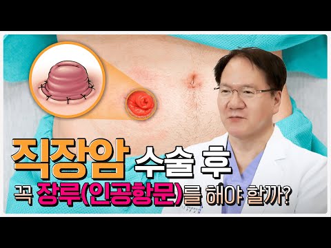 장루에 대한 궁금증? 모두 해결해드립니다!