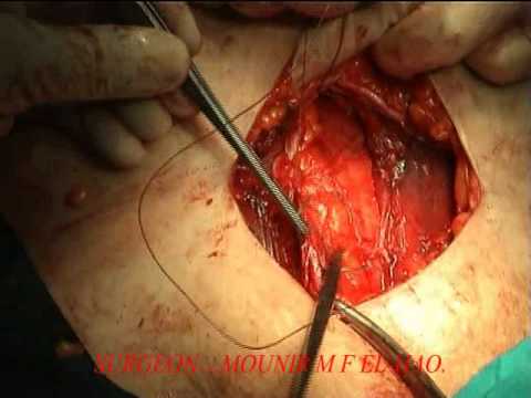 B...TECHNIQUE OF CLOSURE CAESAREAN SECTION (الولادة القيصرية )(PART 2 )