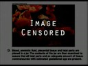 ABORTION - Suction And Curettage / Vacuum Aspiration of a 9 Week Unborn Baby Illustrated Video