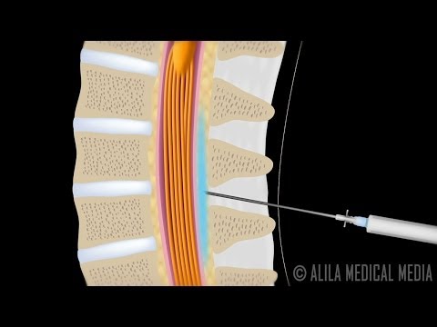 how to relieve epidural back pain