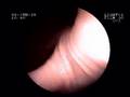 3) Endoscopy : Hiatal hernia