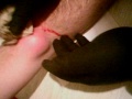 popping a soft ball size cyst