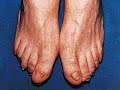 alpha lipid alphalipid parkinson colostrum kolostrum kesihatan diabetes kencing manis darah tinggi gout antiaging anti-aging antibodies growth factor brain food new image omegatrend