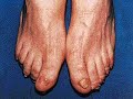 Parkinson Alpha Lipid Sarapan Semulajadi Kesihatan Parkinson Alpha Lipid Sarapan Semulajadi Kesihatan