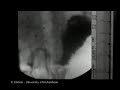 Upper GI Movies - giant contraction and vomiting