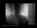 Upper GI Movies - giant contraction and vomiting