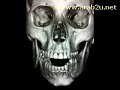 3D skull reconstruction