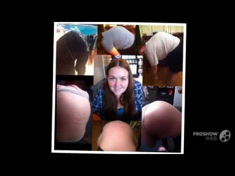 how to cure scheuermann's kyphosis