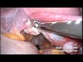 (SILS) Single incision laparoscopic salpingectomy using only a small incision in the umbilicus to remove the fallopian tubes and cysts. Ovaries are not removed. The scar is not visible in belly button.