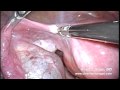 Salpingectomy - LESS, SILS, SPA Technique Salpingectomy - LESS, SILS, SPA Technique