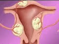 Uterine Fibroid Embolization