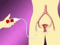 Uterine Fibroid Embolization