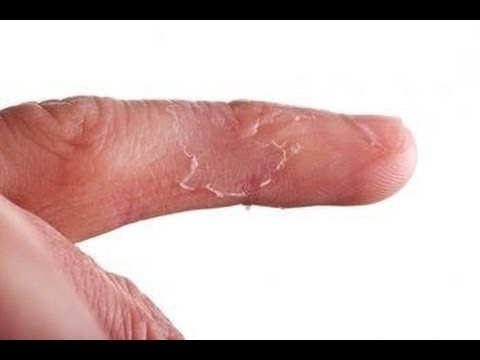 how to cure split fingertips