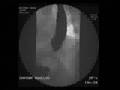 Barium Swallow