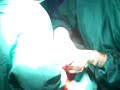 caesarean