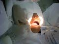 Cirurgia descolamento da gengiva