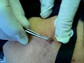 removing the botfly
