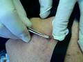 removing the botfly