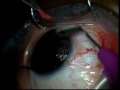 pterygium surgery