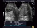 Milena 30 Semanas