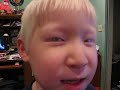 after-nystagmus-surgery.html