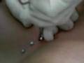 Sternum Dermal Anchor