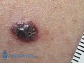Sun Safety - Spotting skin cancer (5min 25sec)