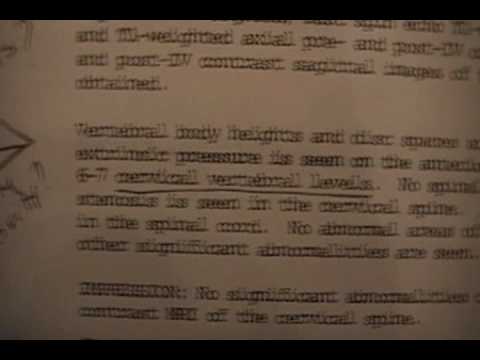 how to eliminate epilepsy